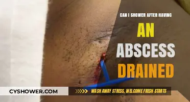 Showering After Abscess Drainage: Safe Practices and Healing Tips