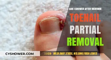 Showering Safely After Ingrown Toenail Partial Removal: What You Need to Know