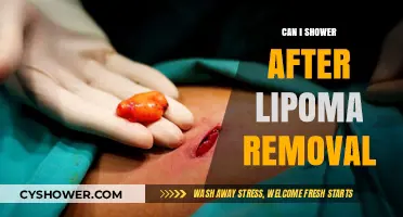 Showering After Lipoma Removal: Safe Practices and Healing Tips