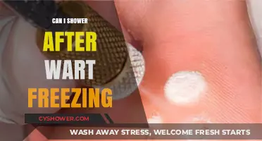 Showering After Wart Freezing: What You Need to Know