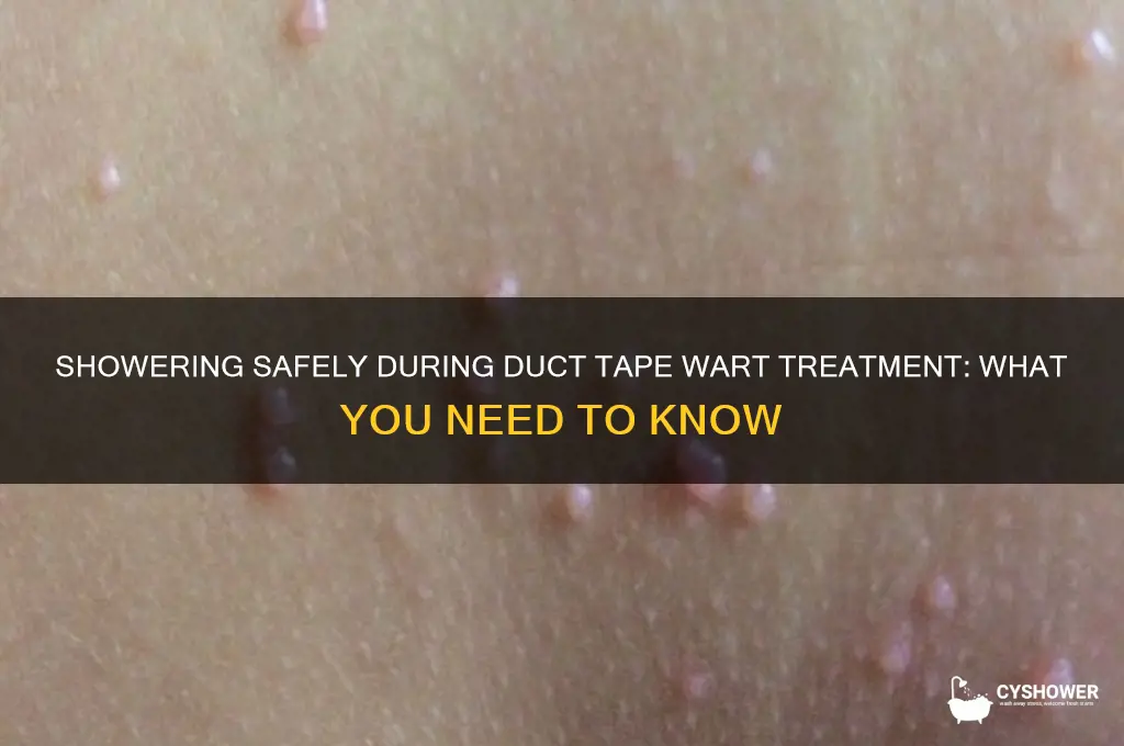 can i shower during duct tape treatment for warts