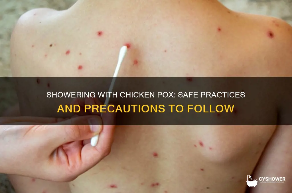can i shower if i have chicken pox