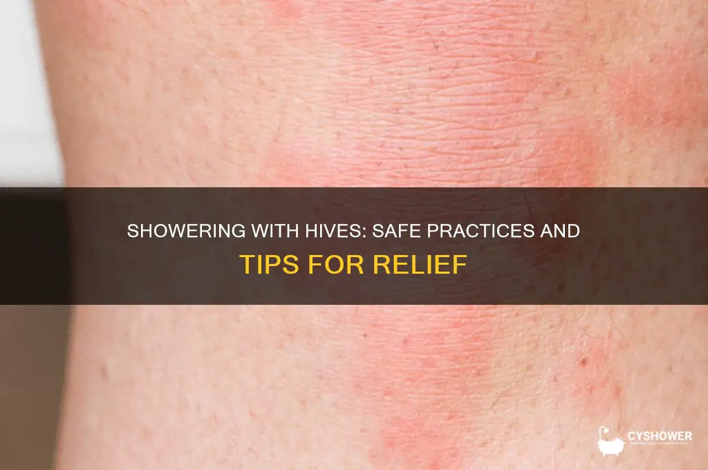 can i shower if i have hives