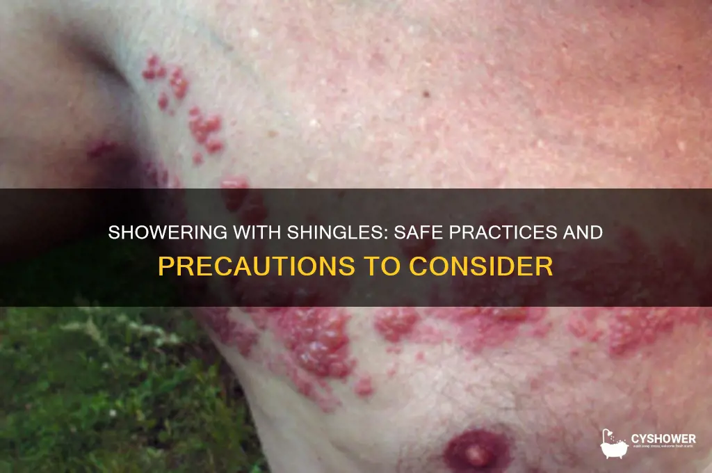 can i shower if i have shingles