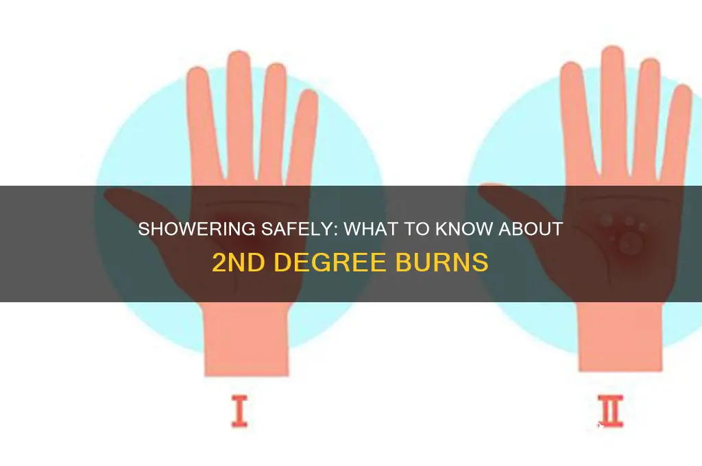 can i shower with 2nd degree burns