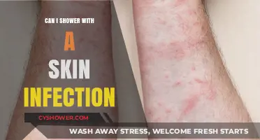 Showering with a Skin Infection: Safe Practices and Precautions