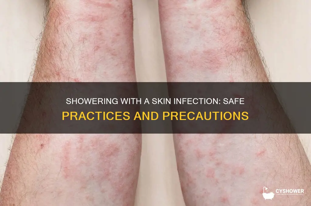 can i shower with a skin infection