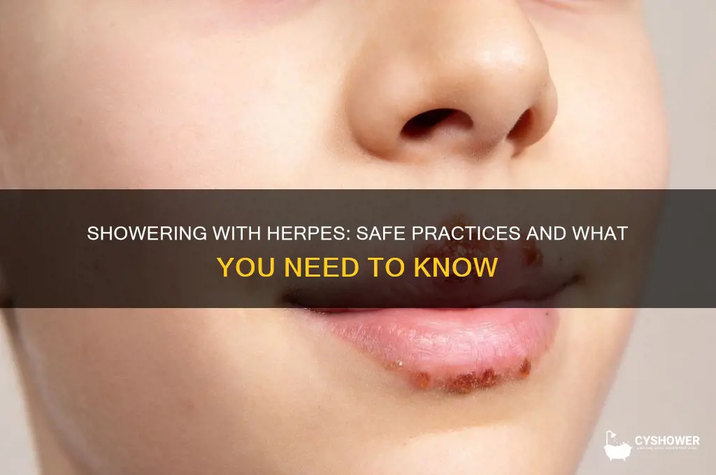 can i shower with herpes
