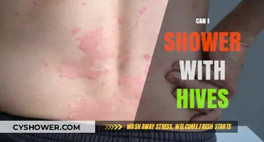 Showering with Hives: Safe Practices and Relief Tips for Itchy Skin