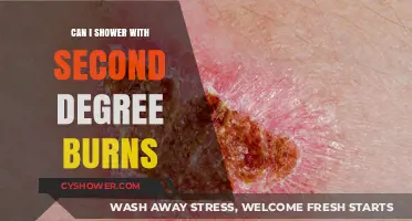 Showering Safely: Second-Degree Burns Care and Healing Tips