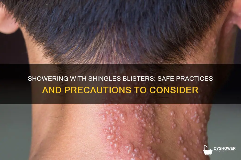 can i shower with shingles blisters