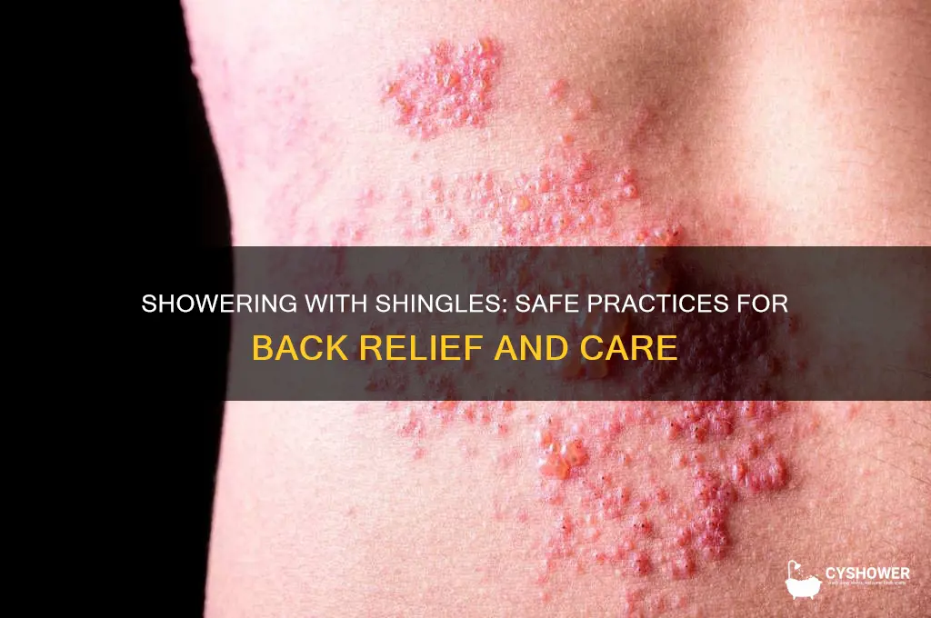 can i shower with shingles on my back