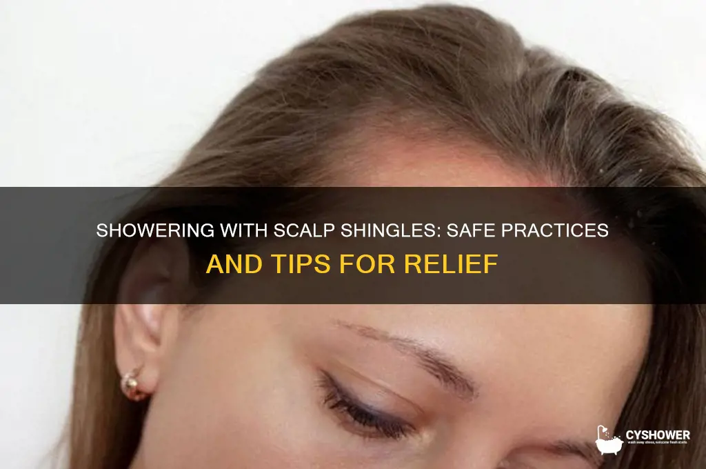 can i shower with shingles on my scalp