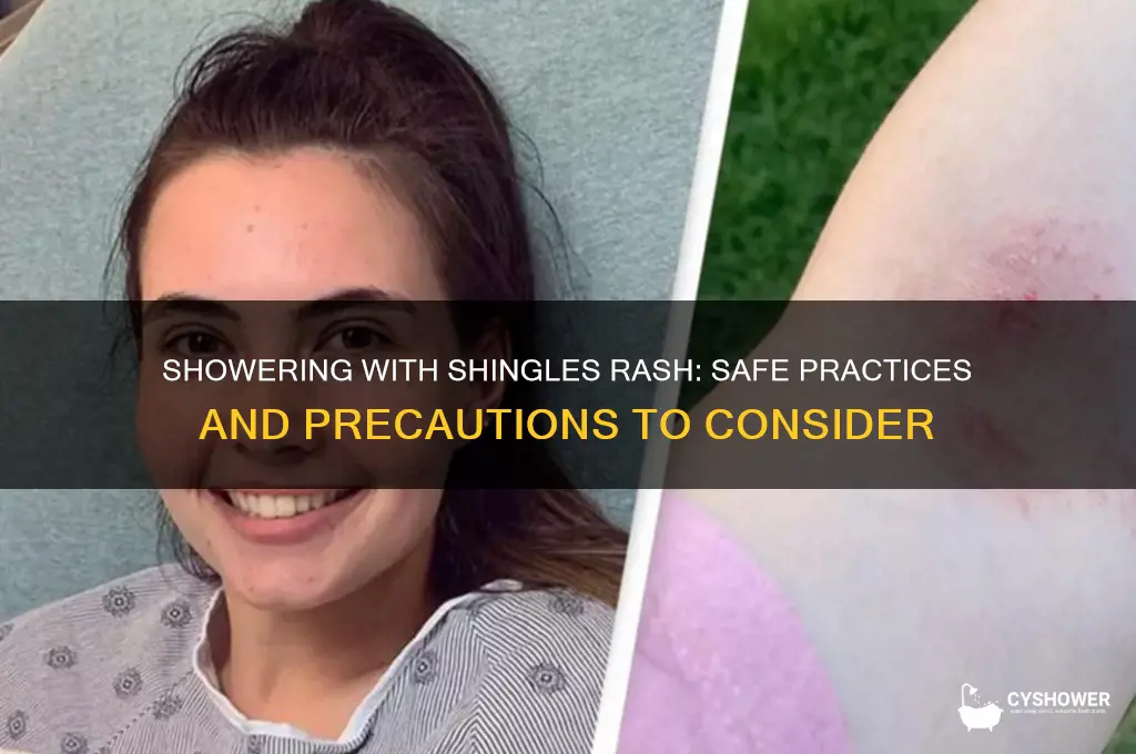 can i shower with shingles rash