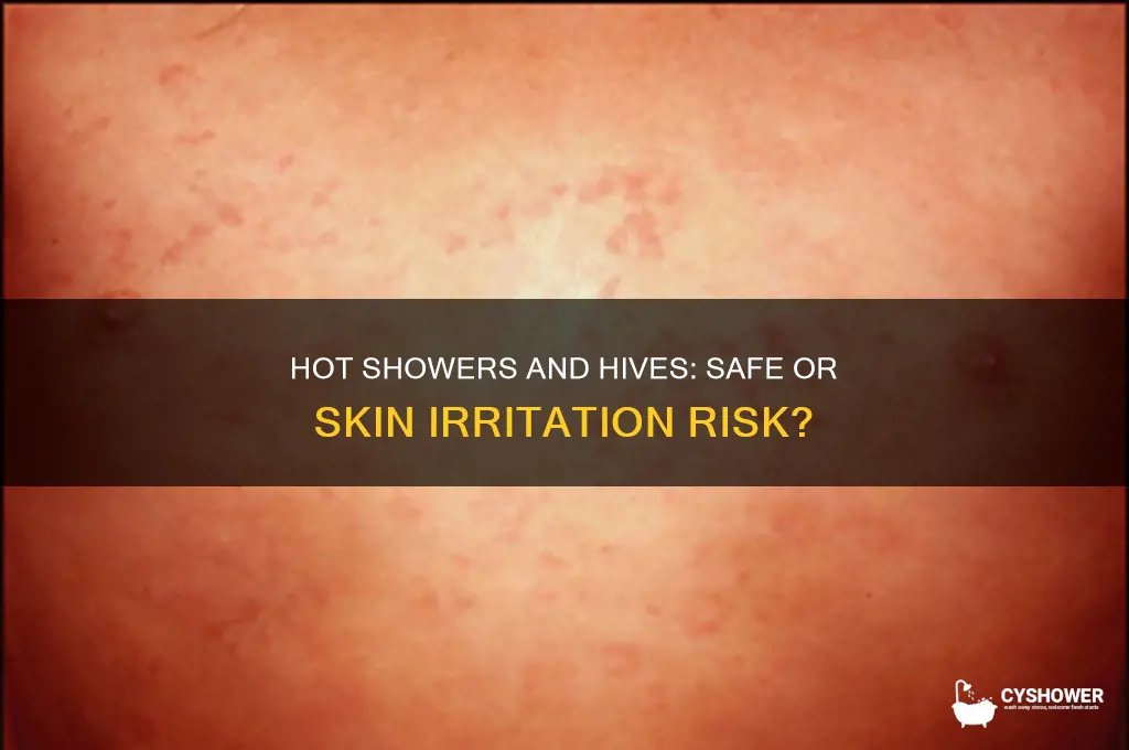 can i take a hot shower with hives