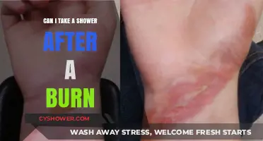 Post-Burn Shower Safety: When and How to Cleanse Safely