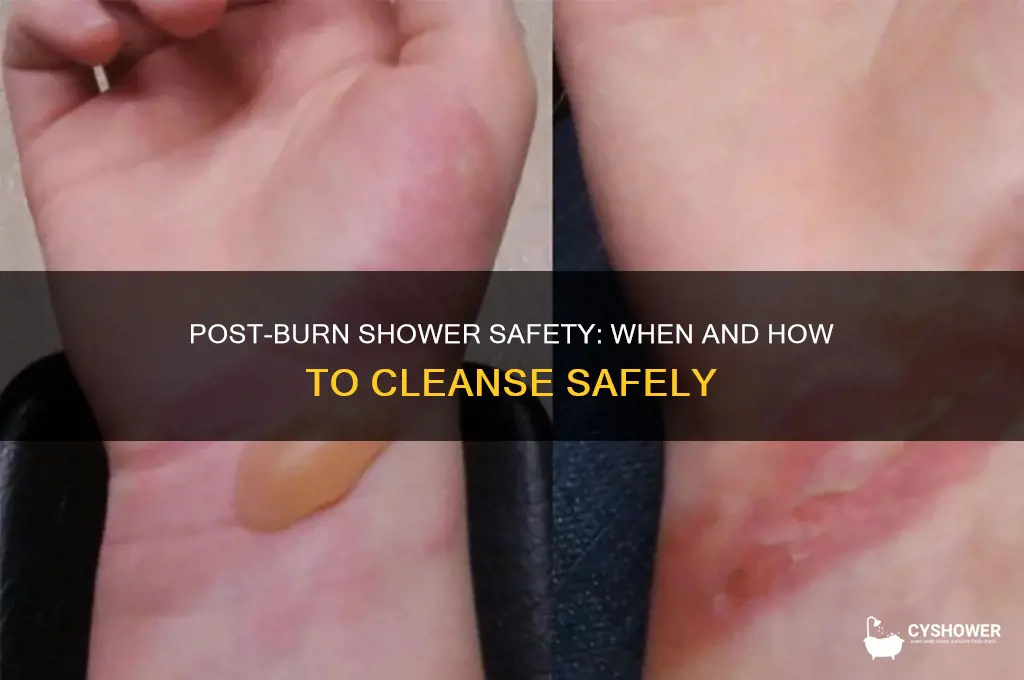 can i take a shower after a burn