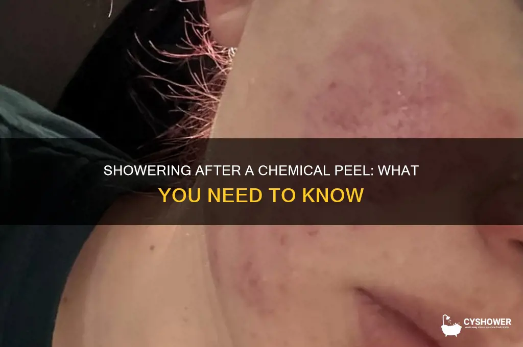 can i take a shower after a chemical peel