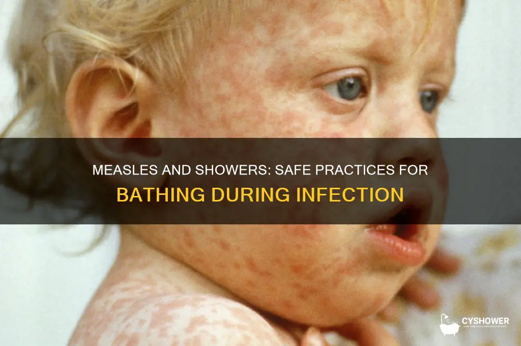 can i take a shower if i have measles