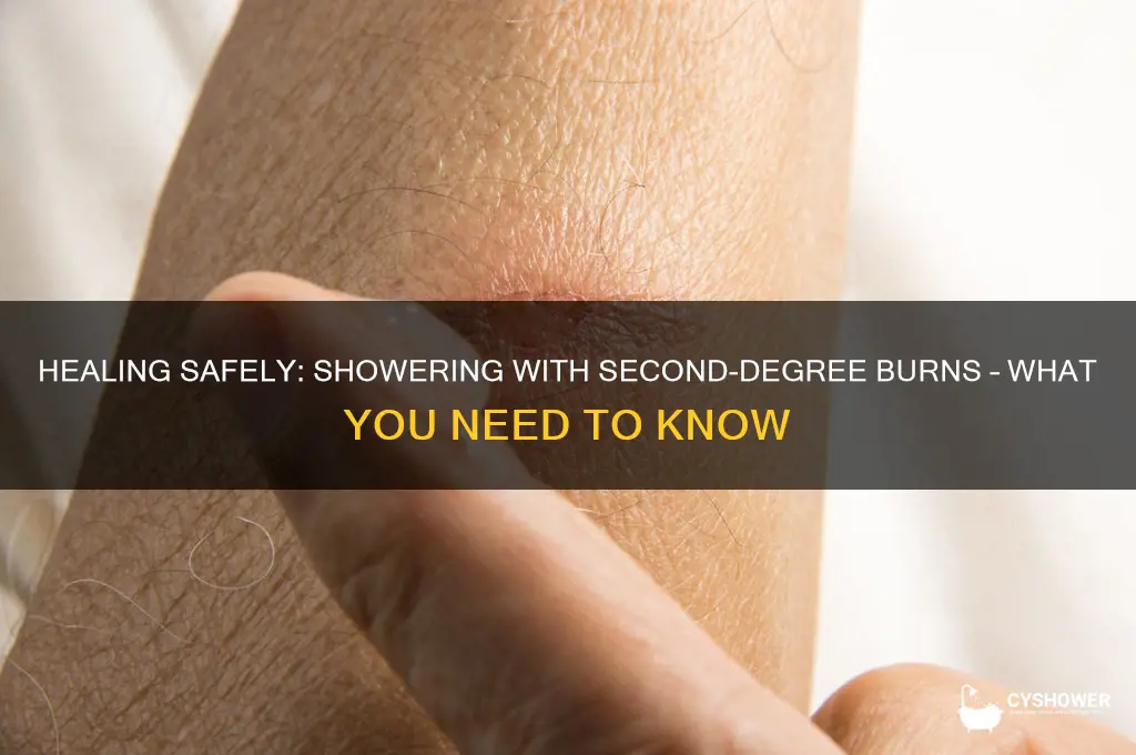 can i take a shower with 2nd degree burns