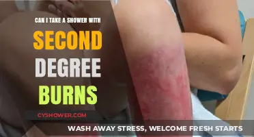 Showering with Second-Degree Burns: Safe Practices and Precautions