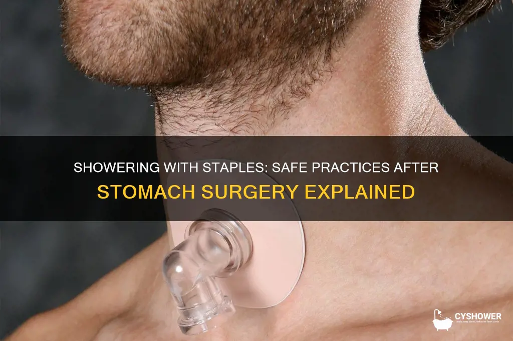 can i take a shower with staples in my stomach