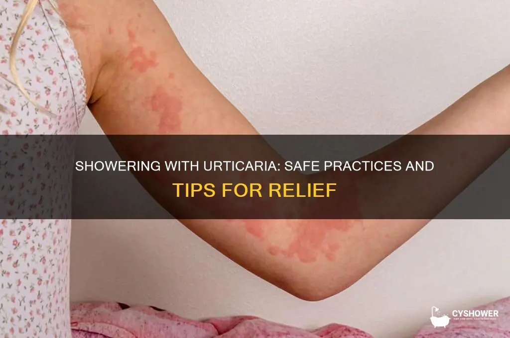 can i take a shower with urticaria