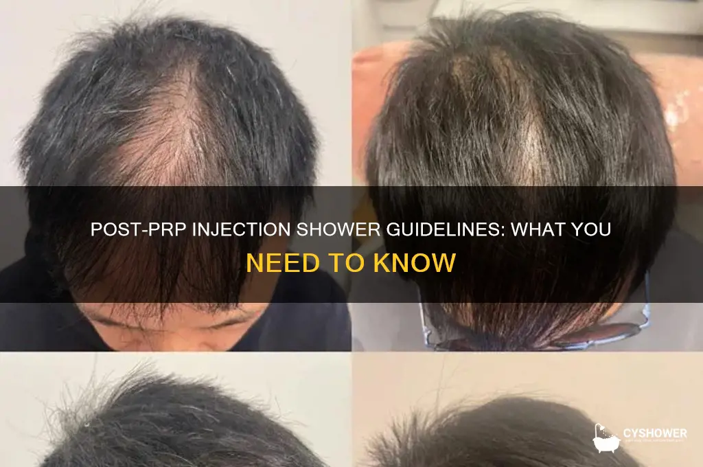 can i take shower after prp injection