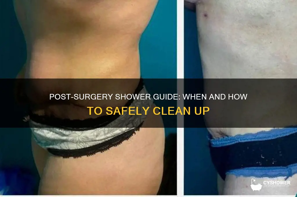 can i take shower after surgery