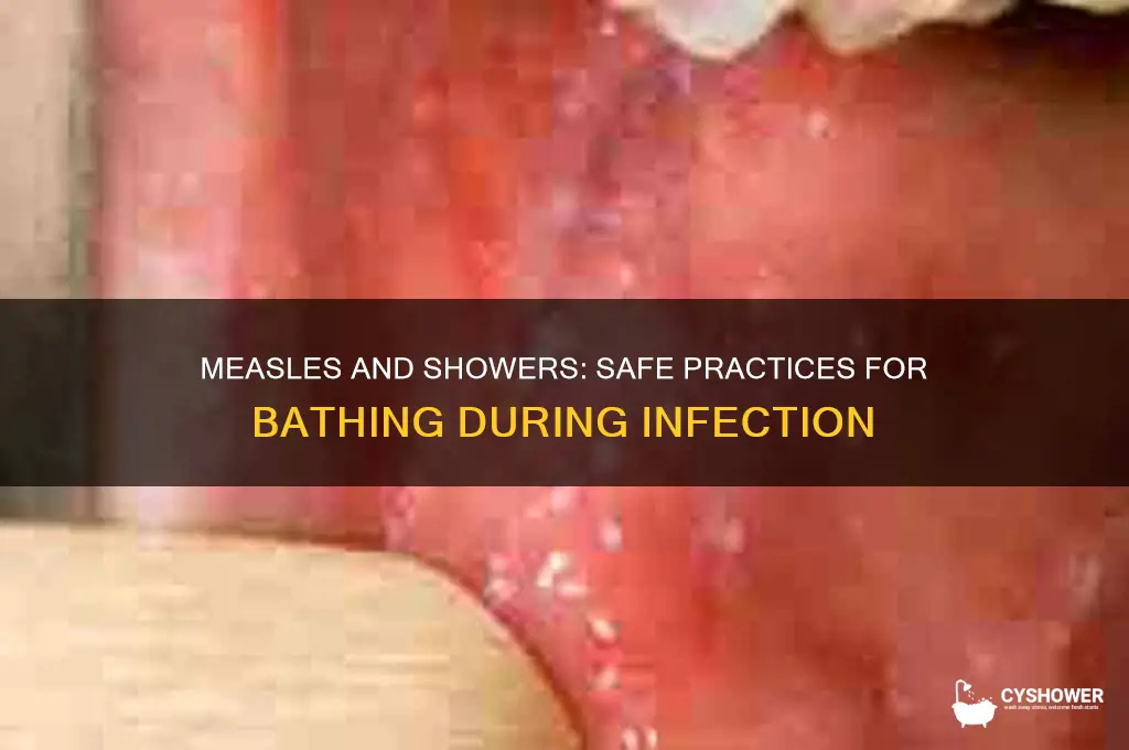 can i take shower in measles