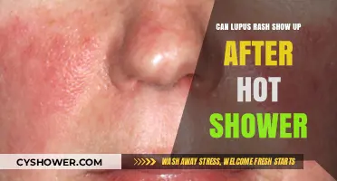 Can Hot Showers Trigger Lupus Rashes? Understanding Post-Shower Skin Reactions