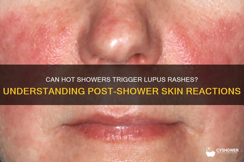 can lupus rash show up after hot shower