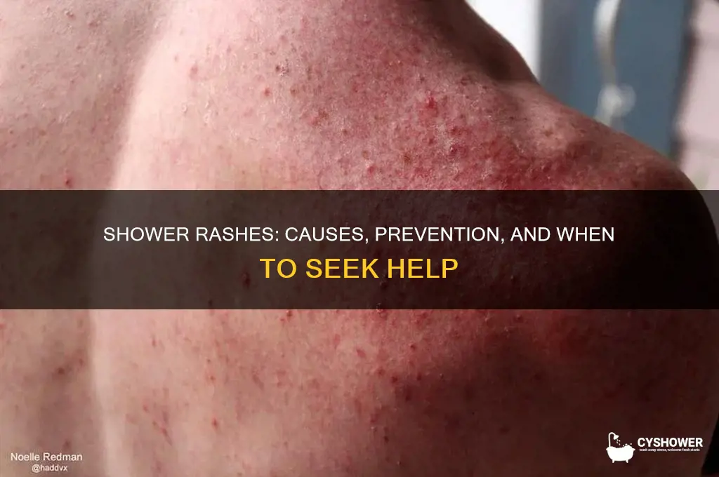 can my shower be giving me a rash