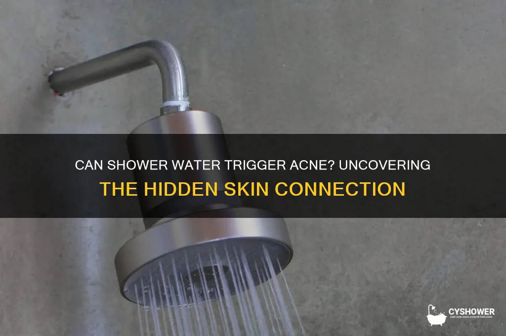 can my shower water cause acne
