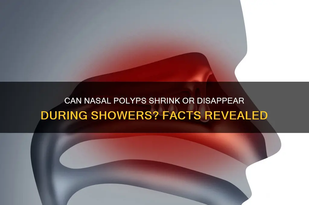 can nasal polyps go away in shower