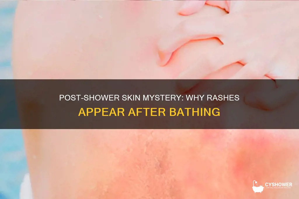 can only see rash after a shower