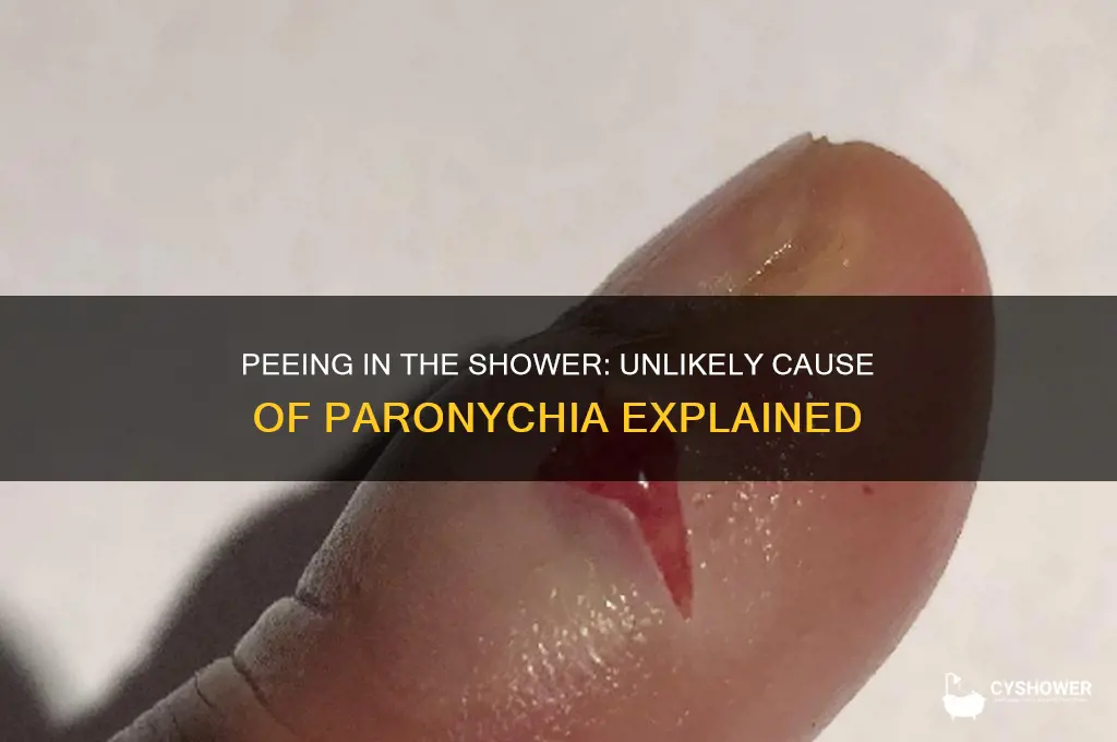 can peeing in the shower cause paronychia