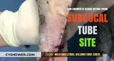 Showering Safely with Slight Oozing from Surgical Tube Site: Tips