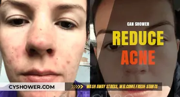 Can Showers Reduce Acne? Uncovering the Truth Behind This Skin Myth