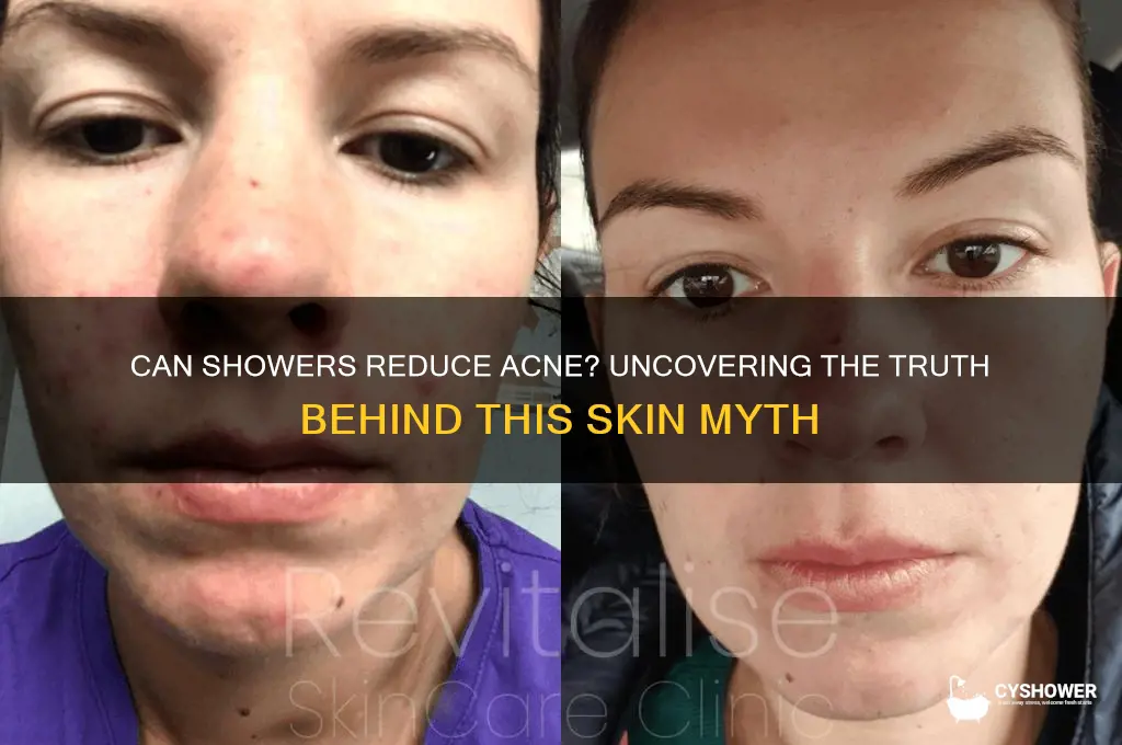 can shower reduce acne