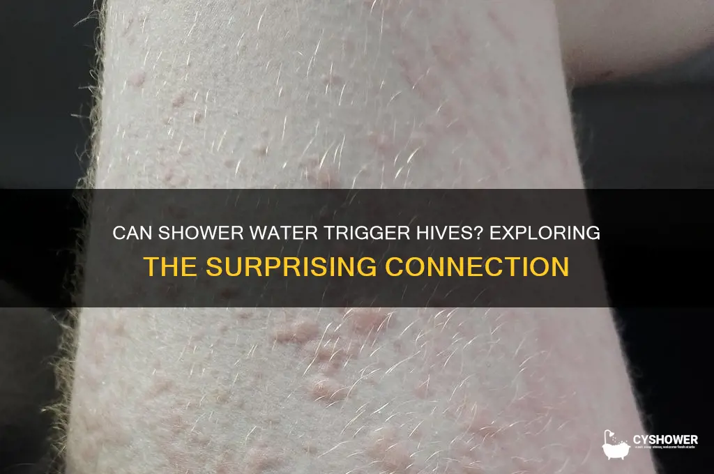 can shower water cause hives