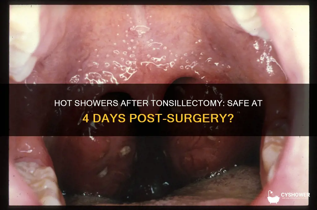 can take hot shower 4 days after tonsillectomy