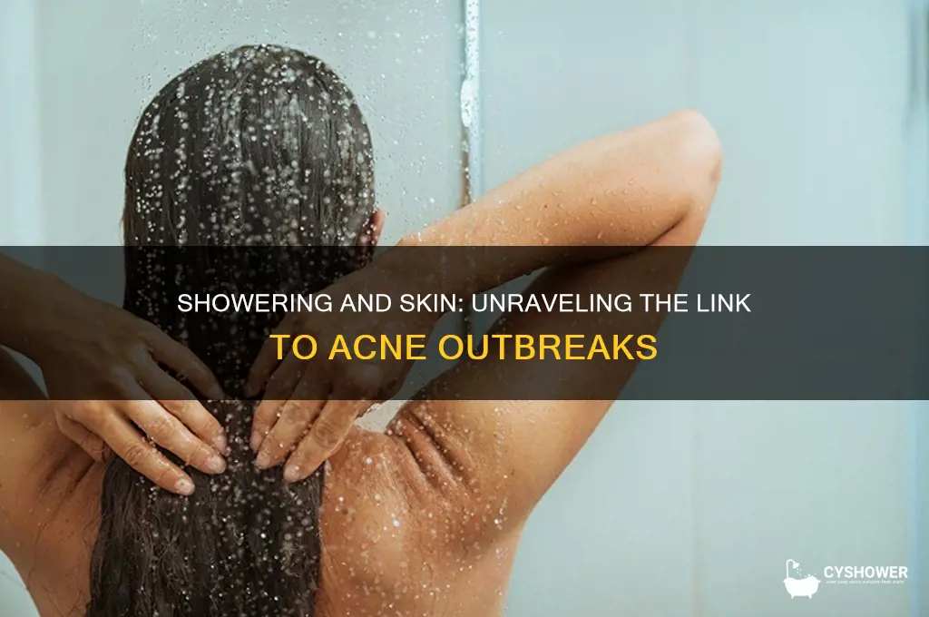 can taking a shower cause acne outbreaks