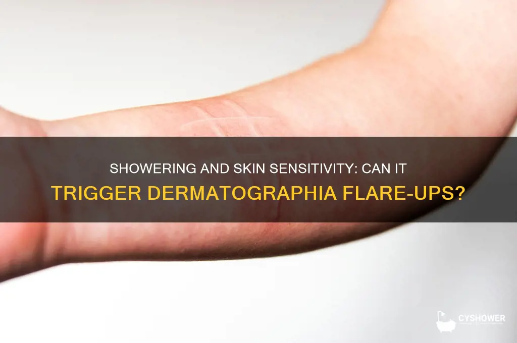 can taking a shower inflame dermatographia