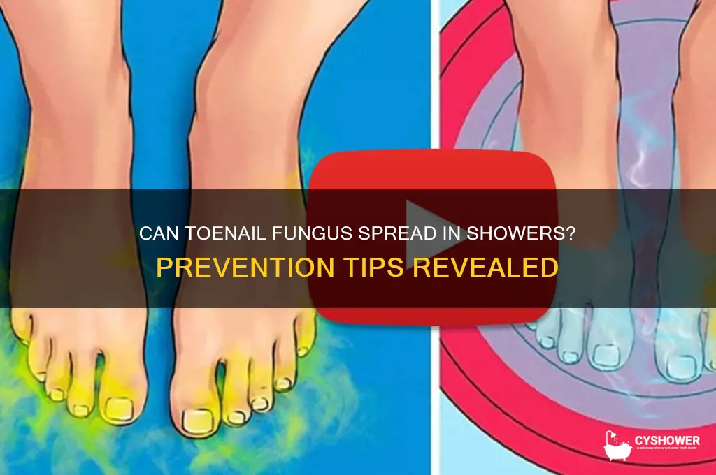 can toenail fungus spread in shower