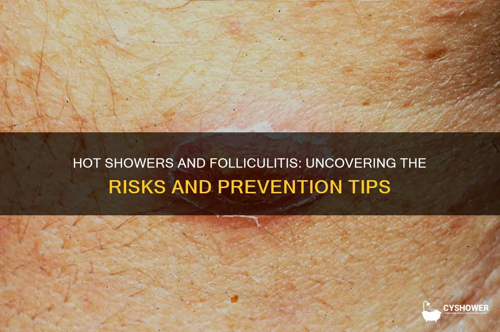 can too hot a shower cause follicilitus