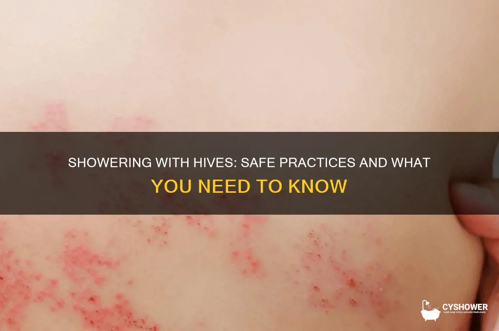 can uou shower with hives