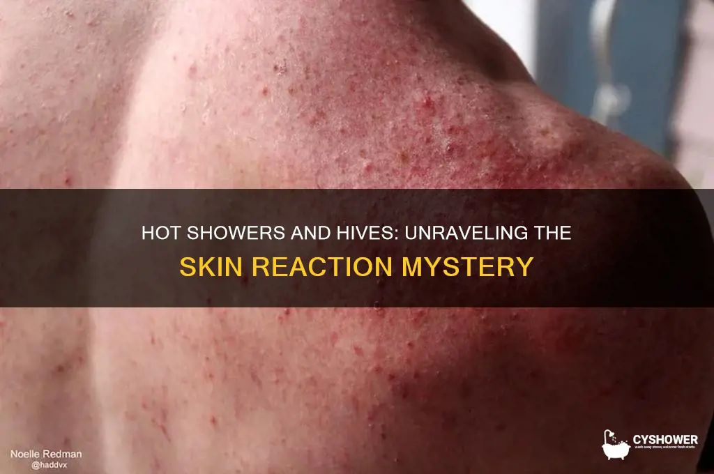 can you get hives from hot shower