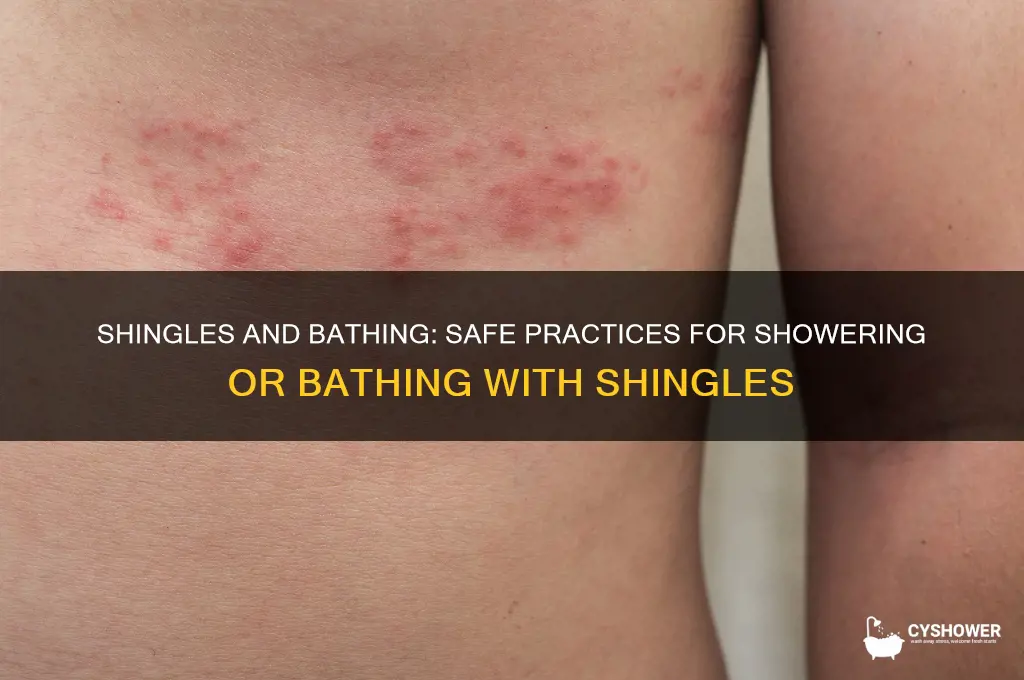 can you have a bath or shower with shingles