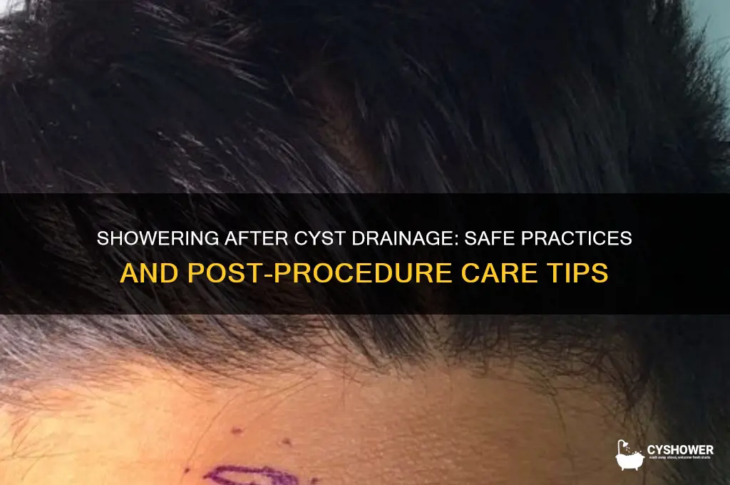 can you shower after getting a cyst drained
